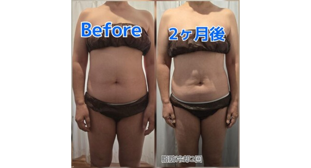 脂肪冷却マシンカップNo.5カップになります！ □脂肪冷却□カップ数は多い方が絶対おススメ！！ | 長野のエステ